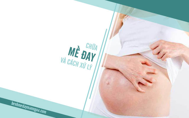 cách chữa mề đay khi mang thai
