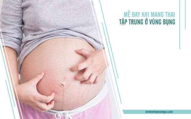 triệu chứng mề đay khi mang thai