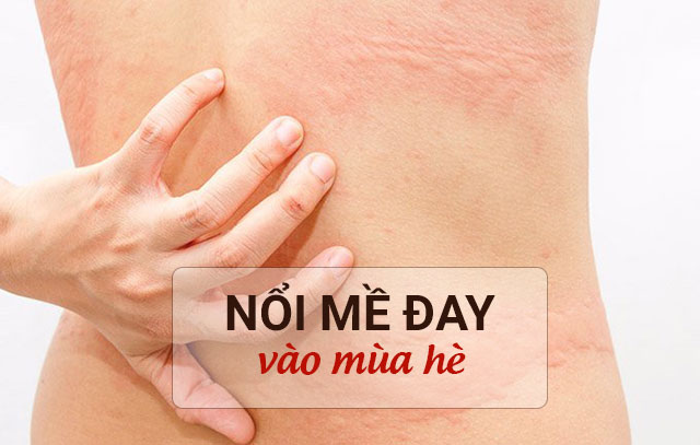 Nổi mề đay vào mùa hè rất dễ xảy ra nếu không áp dụng các biện pháp phòng ngừa thích hợp