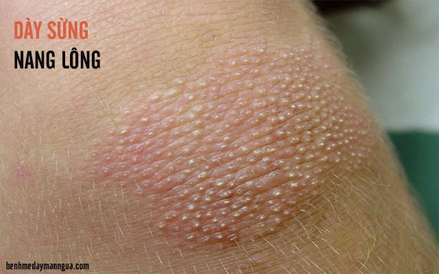 ngứa da do dày sừng nang lông