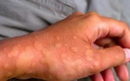 Dị ứng da, mề đay là nguyên nhân khá phổ biến gây ngứa và nổi cục