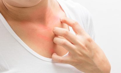 dị ứng là gì
