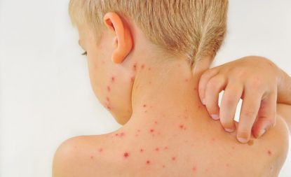 trẻ bị nổi mẩn ngứa
