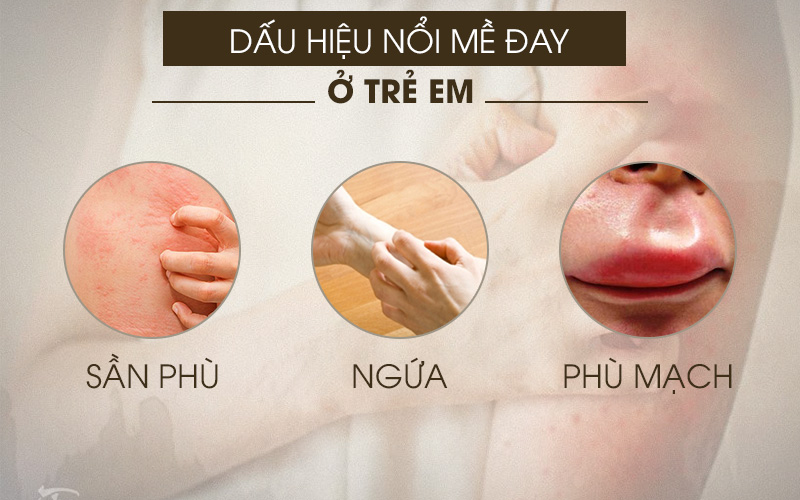 Dấu hiệu nổi mề đay, mẩn ngứa ở trẻ em phổ biến nhất hiện nay
