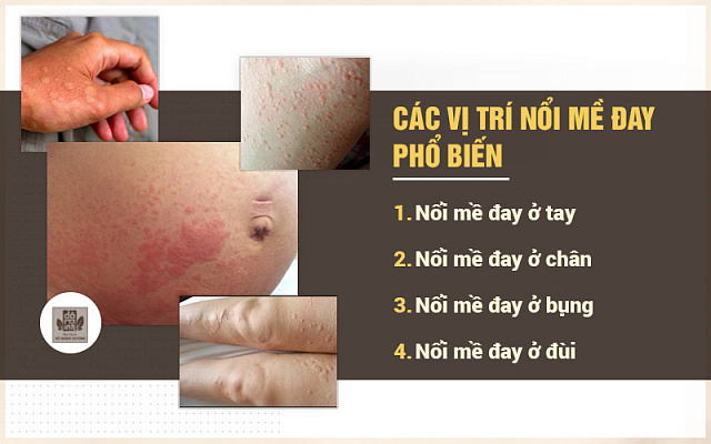 Các vị trí nổi mẩn mề đay