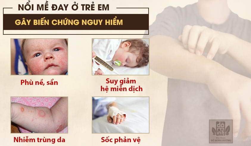 Cảnh giác trước những rủi ro đến với trẻ nhỏ bị nổi mề đay