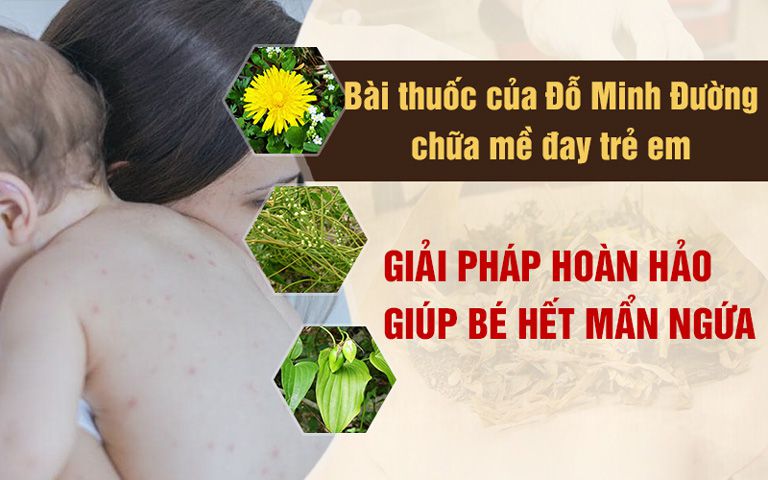 Mề đay Đỗ Minh giải pháp được khuyên dùng cho trẻ